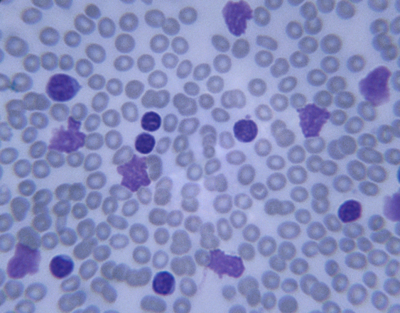 Finding the Source of Cancer Recurrence